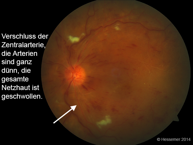 Gef verschl sse Der Netzhaut Augenmedizin Darmstadt